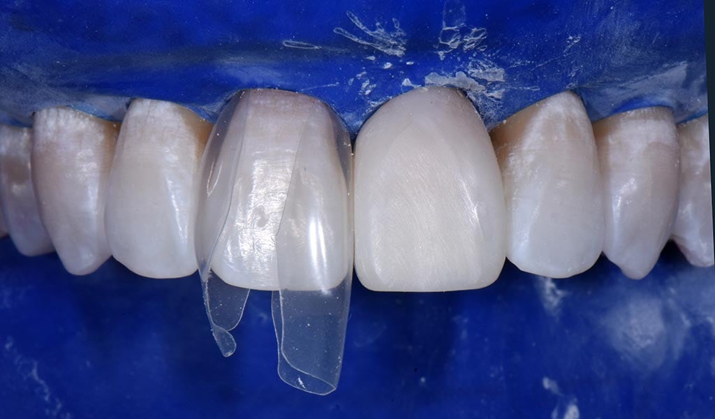 How Bioclear Empowers Dentists To Treat Black Triangles Optident
